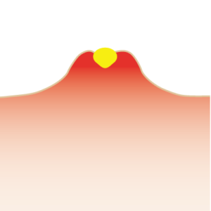 ニキビ跡-黄ニキビ