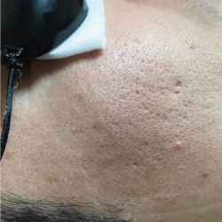 ニキビ跡-クレーター