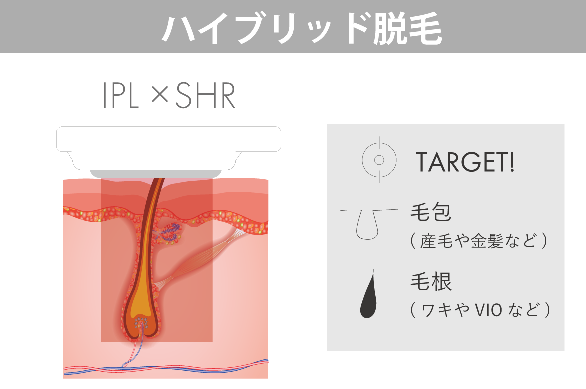 IPL&SHR対応のハイブリッド脱毛の図